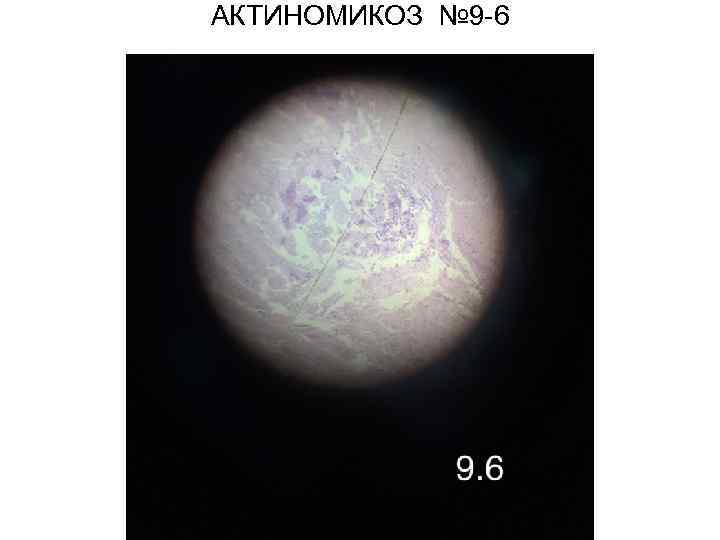 АКТИНОМИКОЗ № 9 -6 