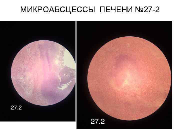 МИКРОАБСЦЕССЫ ПЕЧЕНИ № 27 -2 