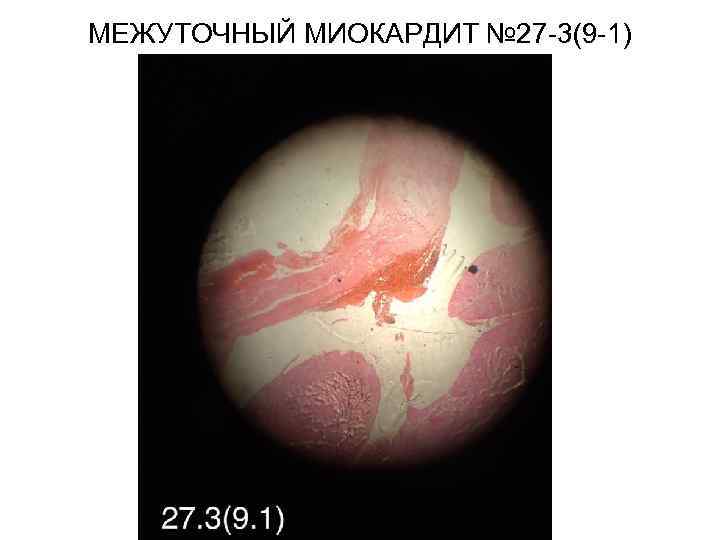 МЕЖУТОЧНЫЙ МИОКАРДИТ № 27 -3(9 -1) 