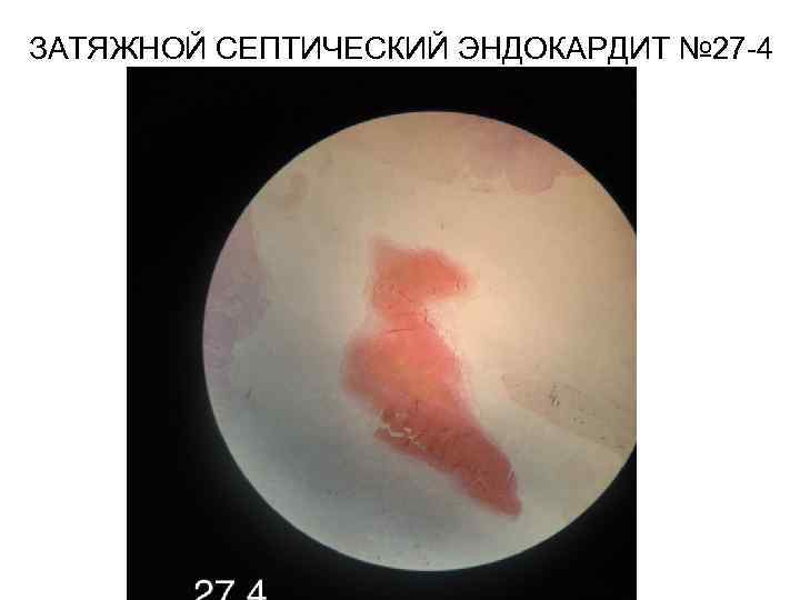 ЗАТЯЖНОЙ СЕПТИЧЕСКИЙ ЭНДОКАРДИТ № 27 -4 
