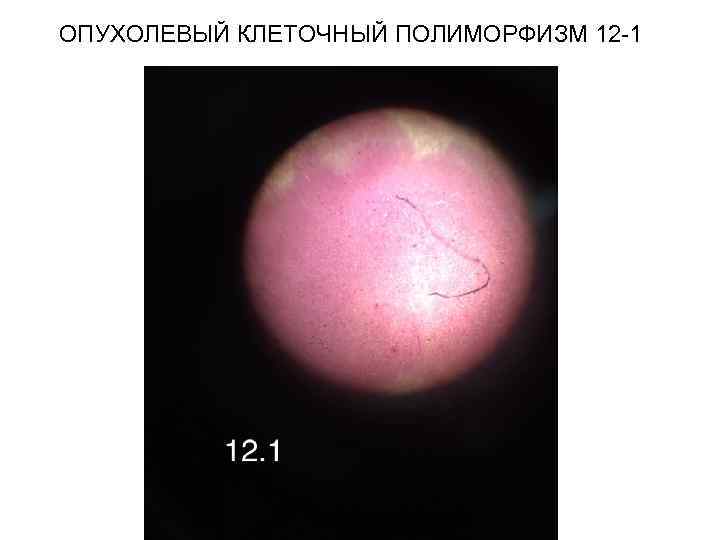 ОПУХОЛЕВЫЙ КЛЕТОЧНЫЙ ПОЛИМОРФИЗМ 12 -1 