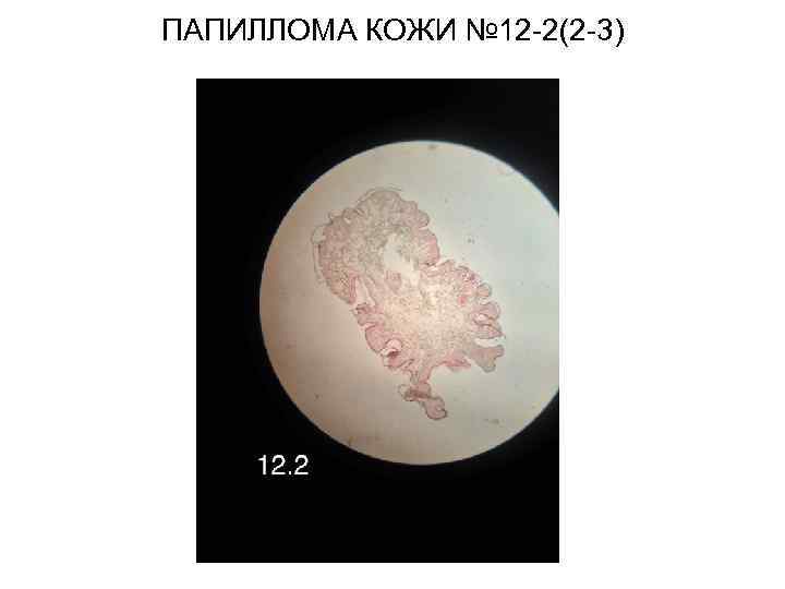 ПАПИЛЛОМА КОЖИ № 12 -2(2 -3) 