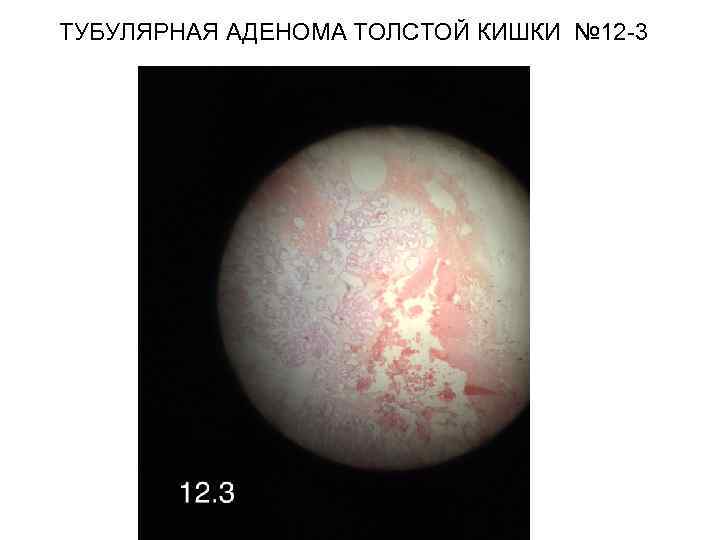 ТУБУЛЯРНАЯ АДЕНОМА ТОЛСТОЙ КИШКИ № 12 -3 