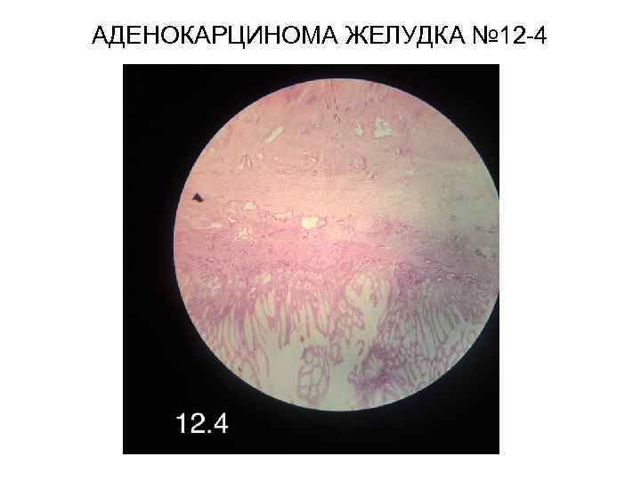 АДЕНОКАРЦИНОМА ЖЕЛУДКА № 12 -4 