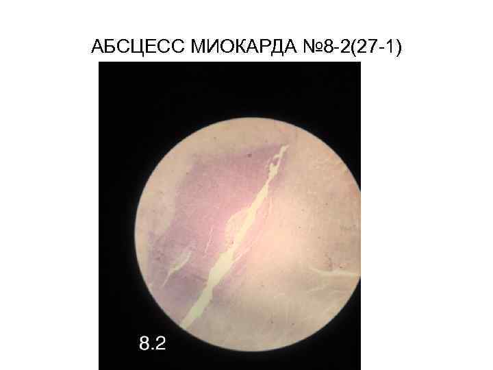 АБСЦЕСС МИОКАРДА № 8 -2(27 -1) 