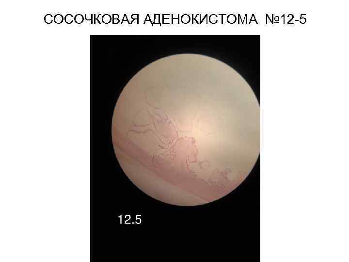 СОСОЧКОВАЯ АДЕНОКИСТОМА № 12 -5 