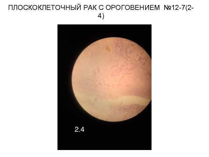 ПЛОСКОКЛЕТОЧНЫЙ РАК С ОРОГОВЕНИЕМ № 12 -7(24) 