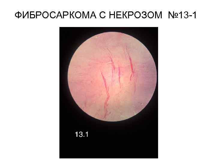 ФИБРОСАРКОМА С НЕКРОЗОМ № 13 -1 