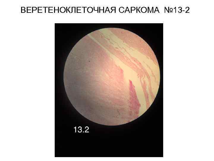 ВЕРЕТЕНОКЛЕТОЧНАЯ САРКОМА № 13 -2 