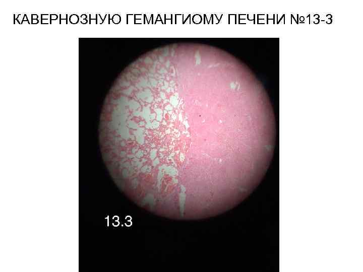 КАВЕРНОЗНУЮ ГЕМАНГИОМУ ПЕЧЕНИ № 13 -3 