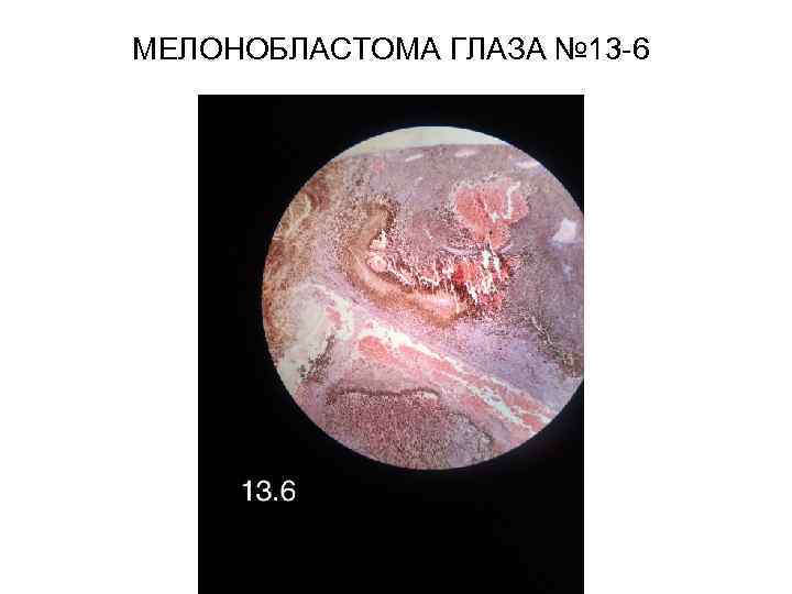 МЕЛОНОБЛАСТОМА ГЛАЗА № 13 -6 