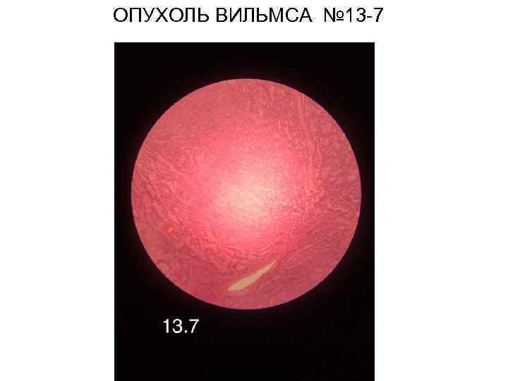 ОПУХОЛЬ ВИЛЬМСА № 13 -7 