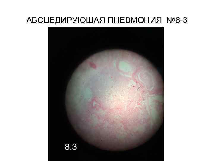 АБСЦЕДИРУЮЩАЯ ПНЕВМОНИЯ № 8 -3 