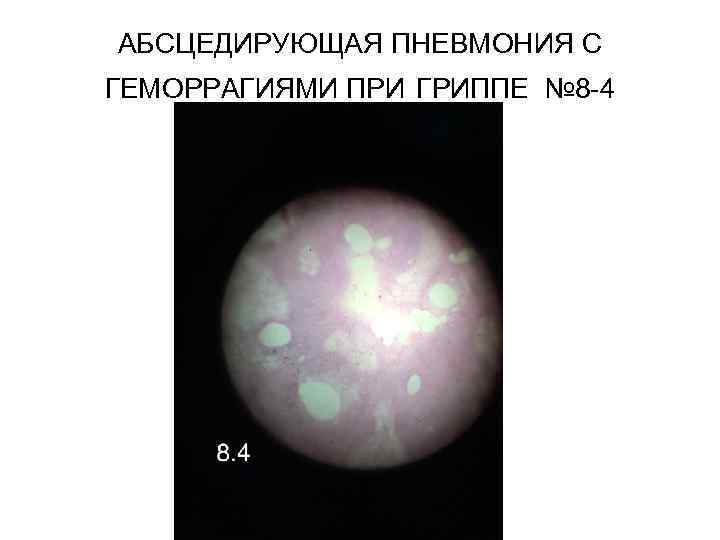 АБСЦЕДИРУЮЩАЯ ПНЕВМОНИЯ С ГЕМОРРАГИЯМИ ПРИ ГРИППЕ № 8 -4 