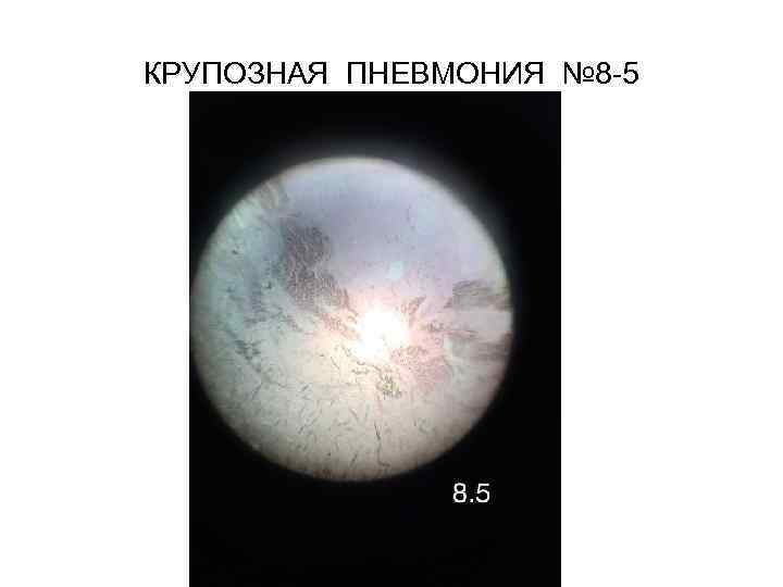 КРУПОЗНАЯ ПНЕВМОНИЯ № 8 -5 