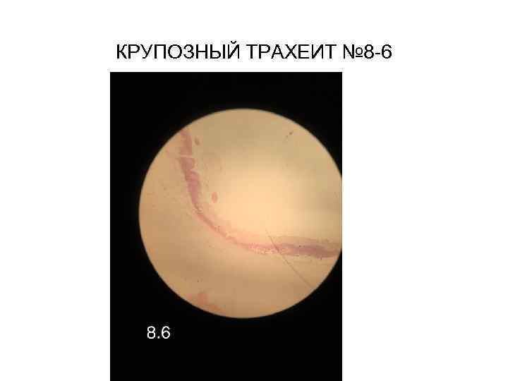 КРУПОЗНЫЙ ТРАХЕИТ № 8 -6 