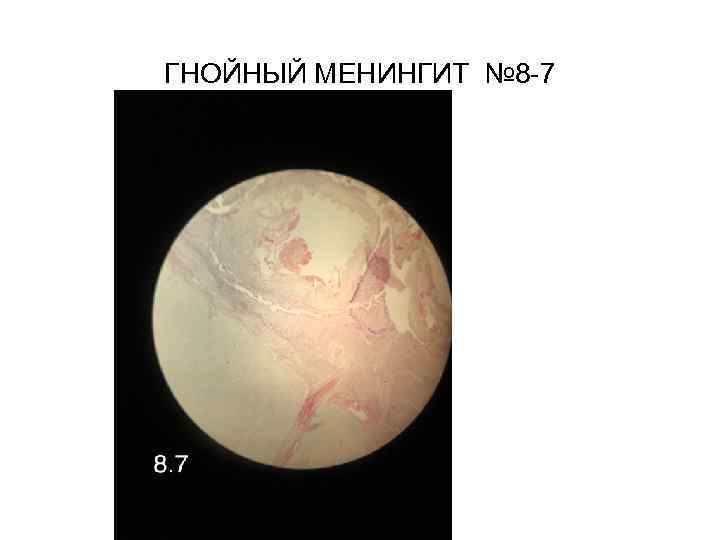 ГНОЙНЫЙ МЕНИНГИТ № 8 -7 