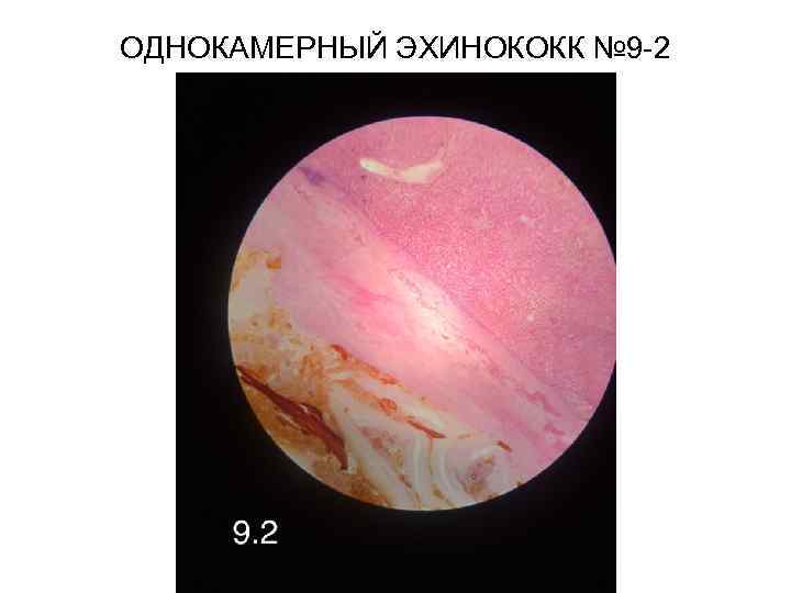 ОДНОКАМЕРНЫЙ ЭХИНОКОКК № 9 -2 