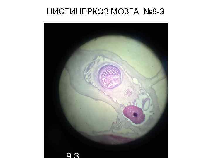 ЦИСТИЦЕРКОЗ МОЗГА № 9 -3 