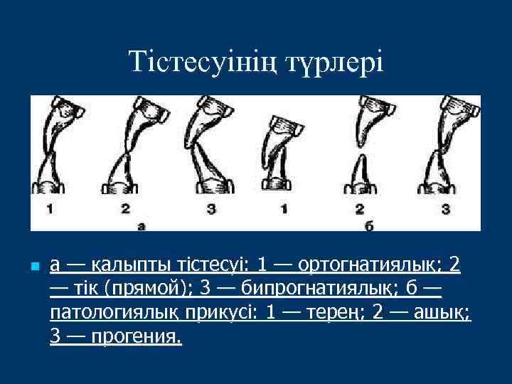 Тістесуінің түрлері n а — қалыпты тістесуі: 1 — ортогнатиялық; 2 — тік (прямой);