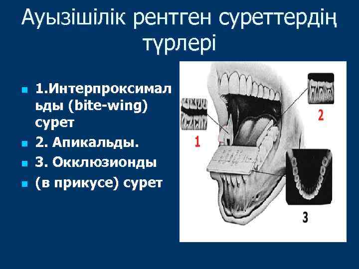 Ауызішілік рентген суреттердің түрлері n n 1. Интерпроксимал ьды (bite-wing) сурет 2. Апикальды. 3.