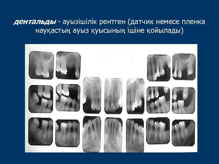 дентальды - ауызішілік рентген (датчик немесе пленка науқастың ауыз қуысының ішіне қойылады) 