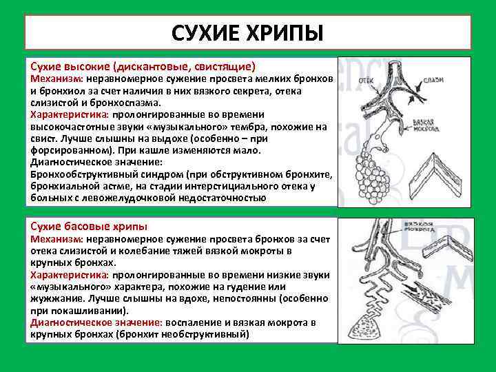 СУХИЕ ХРИПЫ Сухие высокие (дискантовые, свистящие) Механизм: неравномерное сужение просвета мелких бронхов и бронхиол