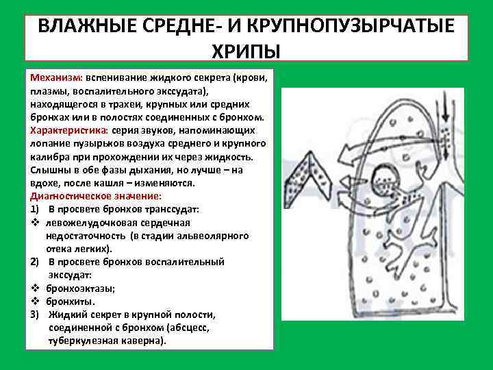 ВЛАЖНЫЕ СРЕДНЕ- И КРУПНОПУЗЫРЧАТЫЕ ХРИПЫ Механизм: вспенивание жидкого секрета (крови, плазмы, воспалительного экссудата), находящегося