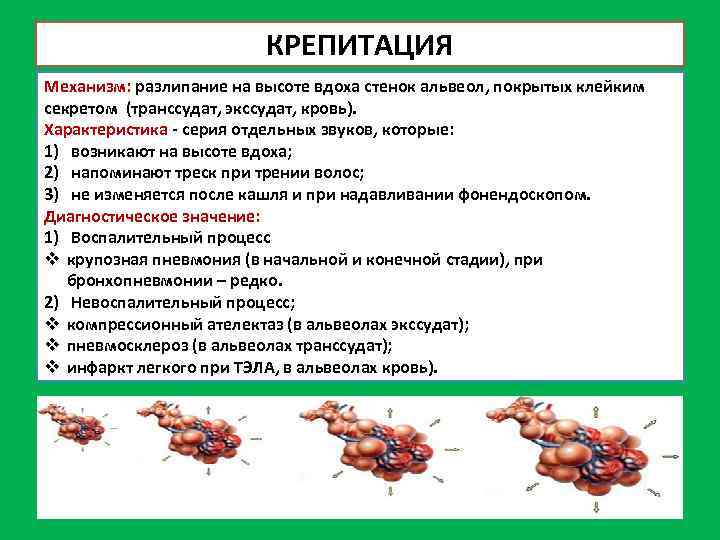 КРЕПИТАЦИЯ Механизм: разлипание на высоте вдоха стенок альвеол, покрытых клейким секретом (транссудат, экссудат, кровь).
