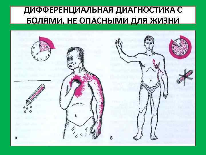 ДИФФЕРЕНЦИАЛЬНАЯ ДИАГНОСТИКА С БОЛЯМИ, НЕ ОПАСНЫМИ ДЛЯ ЖИЗНИ 