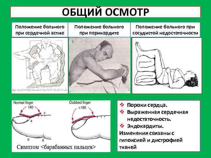 Вынужденное положение тела. Положение больного при перикардите. Перикардит положение больного. Положение больного при сердечной астме. Поза больного при экссудативном перикардите.