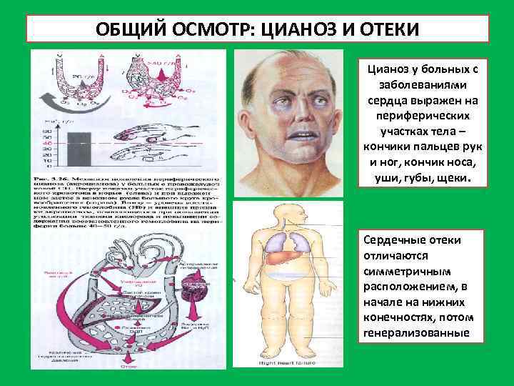 ОБЩИЙ ОСМОТР: ЦИАНОЗ И ОТЕКИ Цианоз у больных с заболеваниями сердца выражен на периферических