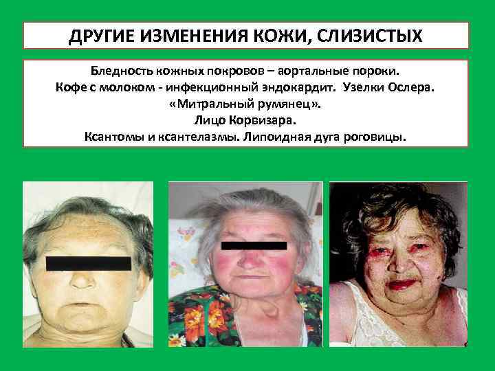 ДРУГИЕ ИЗМЕНЕНИЯ КОЖИ, СЛИЗИСТЫХ Бледность кожных покровов – аортальные пороки. Кофе с молоком -