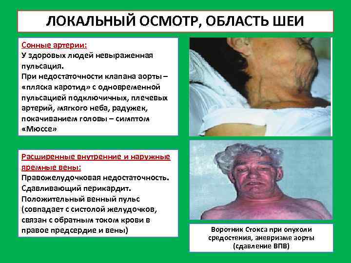 ЛОКАЛЬНЫЙ ОСМОТР, ОБЛАСТЬ ШЕИ Сонные артерии: У здоровых людей невыраженная пульсация. При недостаточности клапана