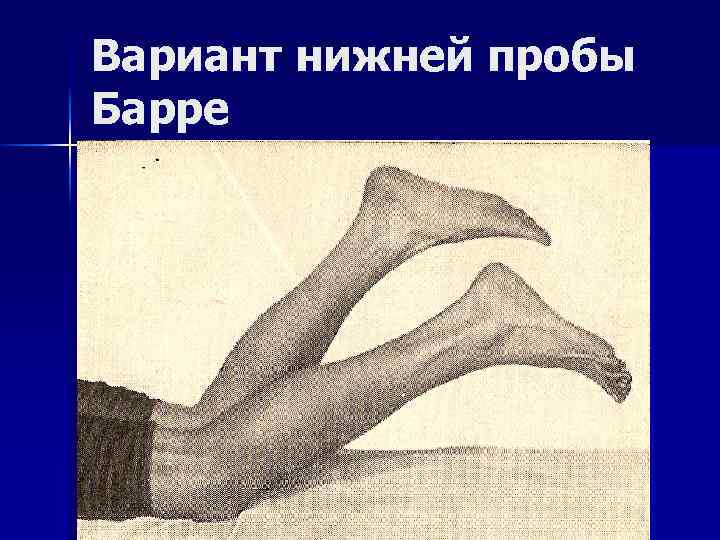 Вариант нижней пробы Барре 