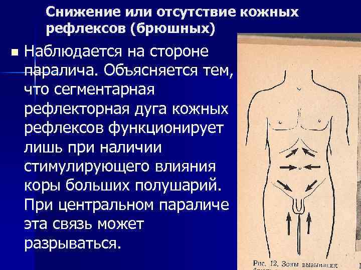 Снижение или отсутствие кожных рефлексов (брюшных) n Наблюдается на стороне паралича. Объясняется тем, что