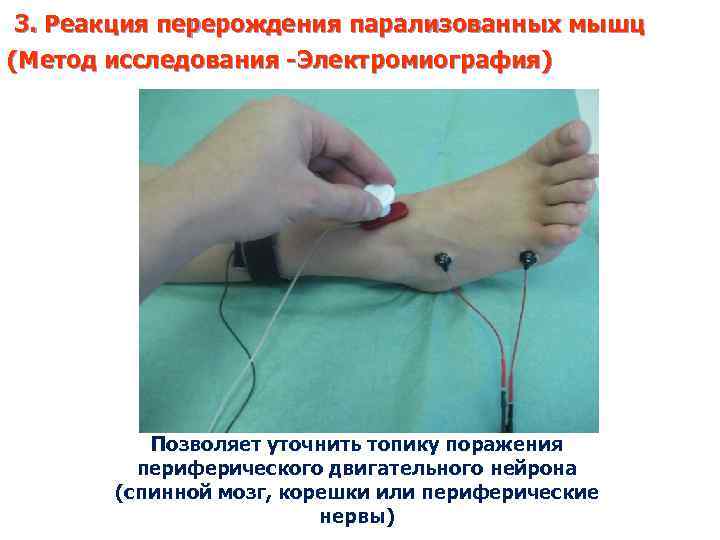 3. Реакция перерождения парализованных мышц (Метод исследования -Электромиография) Позволяет уточнить топику поражения периферического двигательного