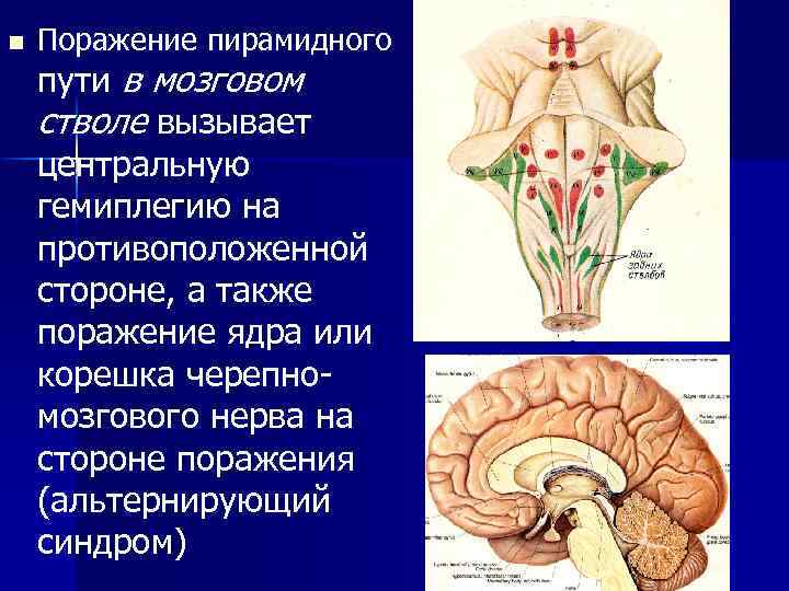 n Поражение пирамидного пути в мозговом стволе вызывает центральную гемиплегию на противоположенной стороне, а