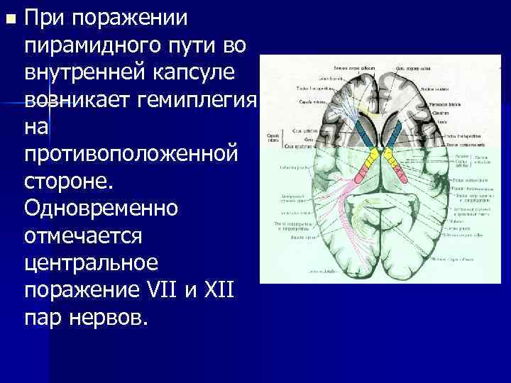 n При поражении пирамидного пути во внутренней капсуле возникает гемиплегия на противоположенной стороне. Одновременно