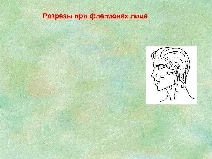 Разрезы при флегмонах лица 