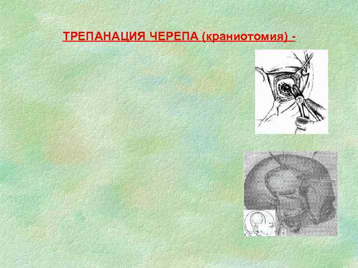 ТРЕПАНАЦИЯ ЧЕРЕПА (краниотомия) - 