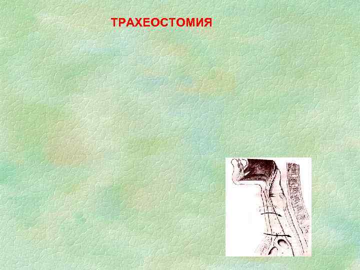 ТРАХЕОСТОМИЯ 