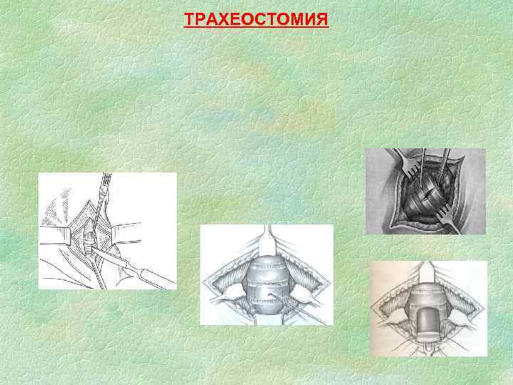 ТРАХЕОСТОМИЯ 