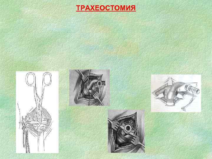 ТРАХЕОСТОМИЯ 