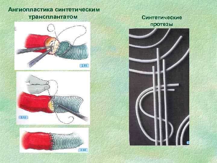 Ангиопластика синтетическим трансплантатом Синтетические протезы 