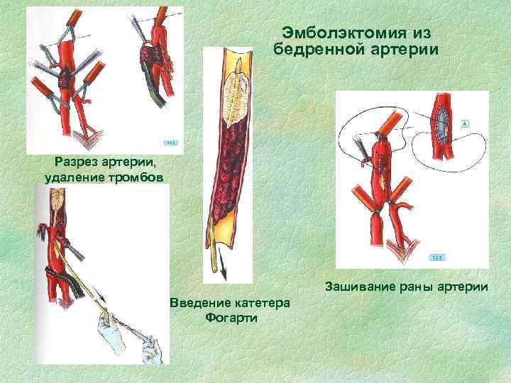 Эмболэктомия из бедренной артерии Разрез артерии, удаление тромбов Зашивание раны артерии Введение катетера Фогарти