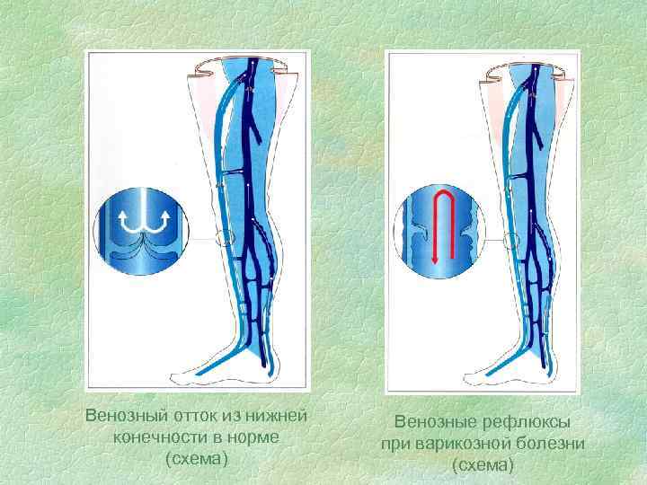 Венозный отток из нижней конечности в норме (схема) Венозные рефлюксы при варикозной болезни (схема)