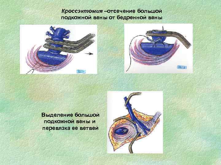 Кроссэктомия –отсечение большой подкожной вены от бедренной вены Выделение большой подкожной вены и перевязка