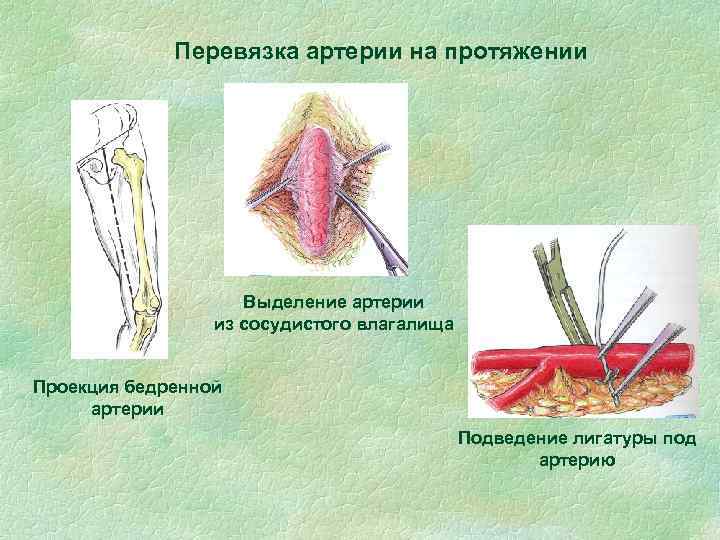 Перевязка артерии на протяжении Выделение артерии из сосудистого влагалища Проекция бедренной артерии Подведение лигатуры