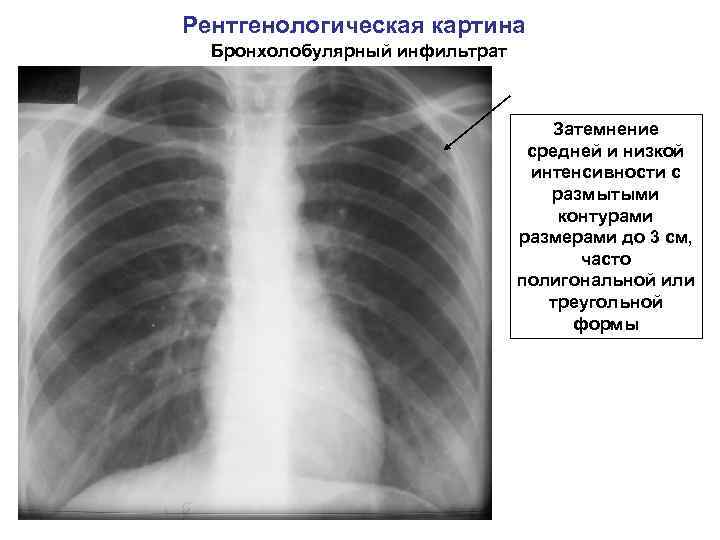 Рентгенологическая картина Бронхолобулярный инфильтрат Затемнение средней и низкой интенсивности с размытыми контурами размерами до